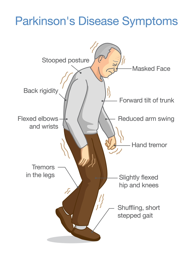 Symptoms of Parkinson's disease