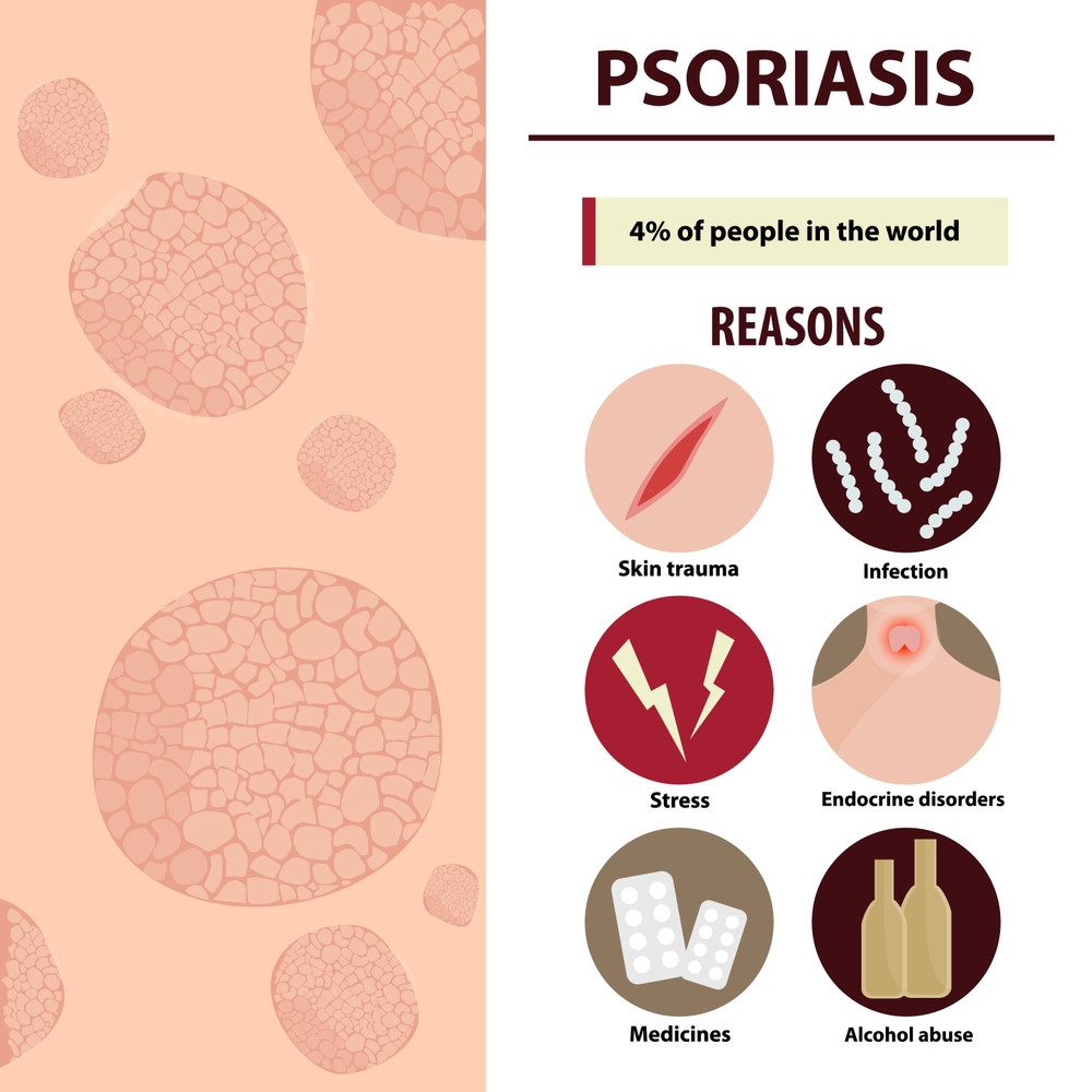 Causes of Psoriasis