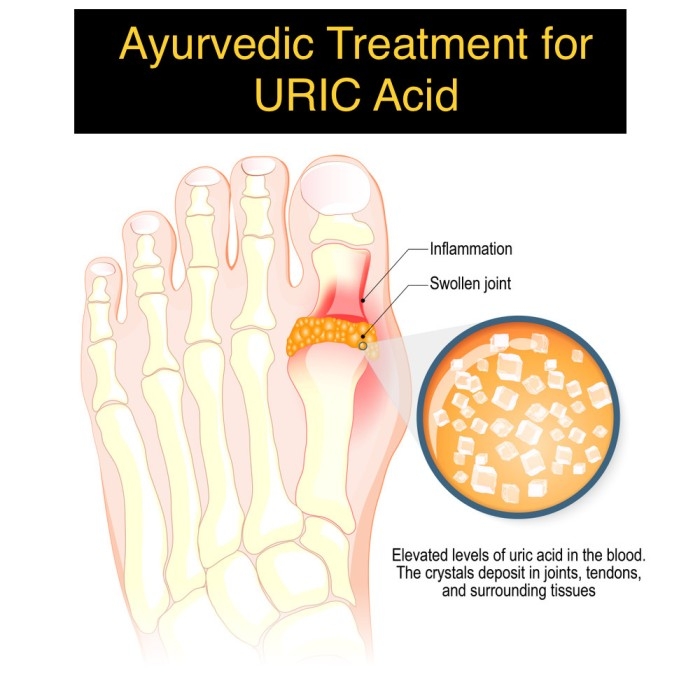 Ayurvedic treatment for Uric Acid - GOUT