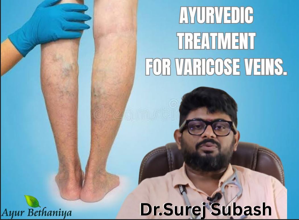 What is Varicose Vein?