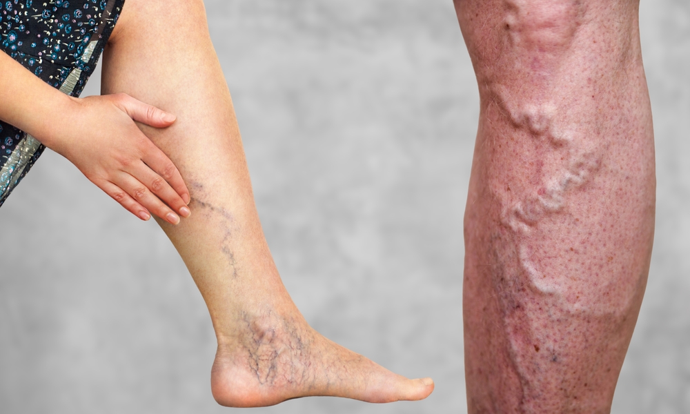 What is Varicose Vein?